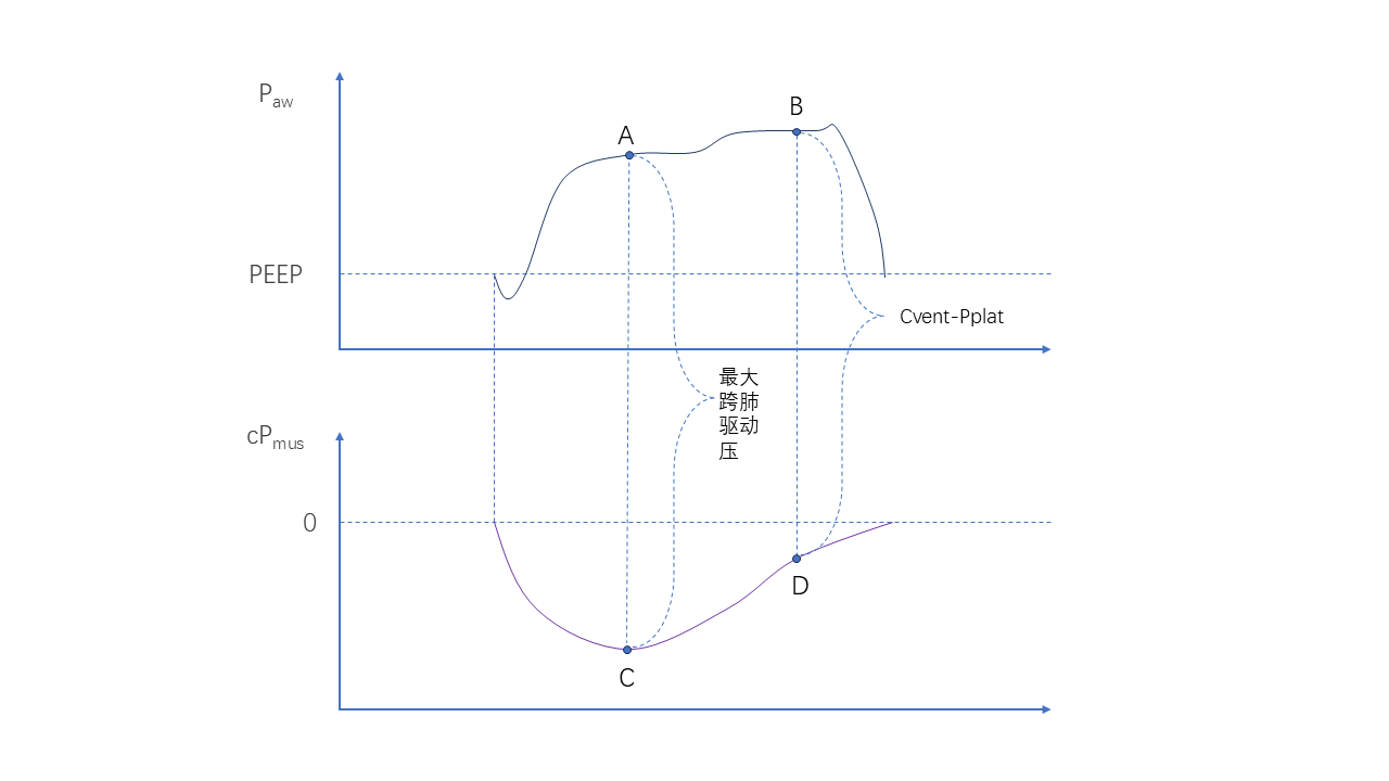 Pmus監(jiān)測--呼吸支持決策新“視”角